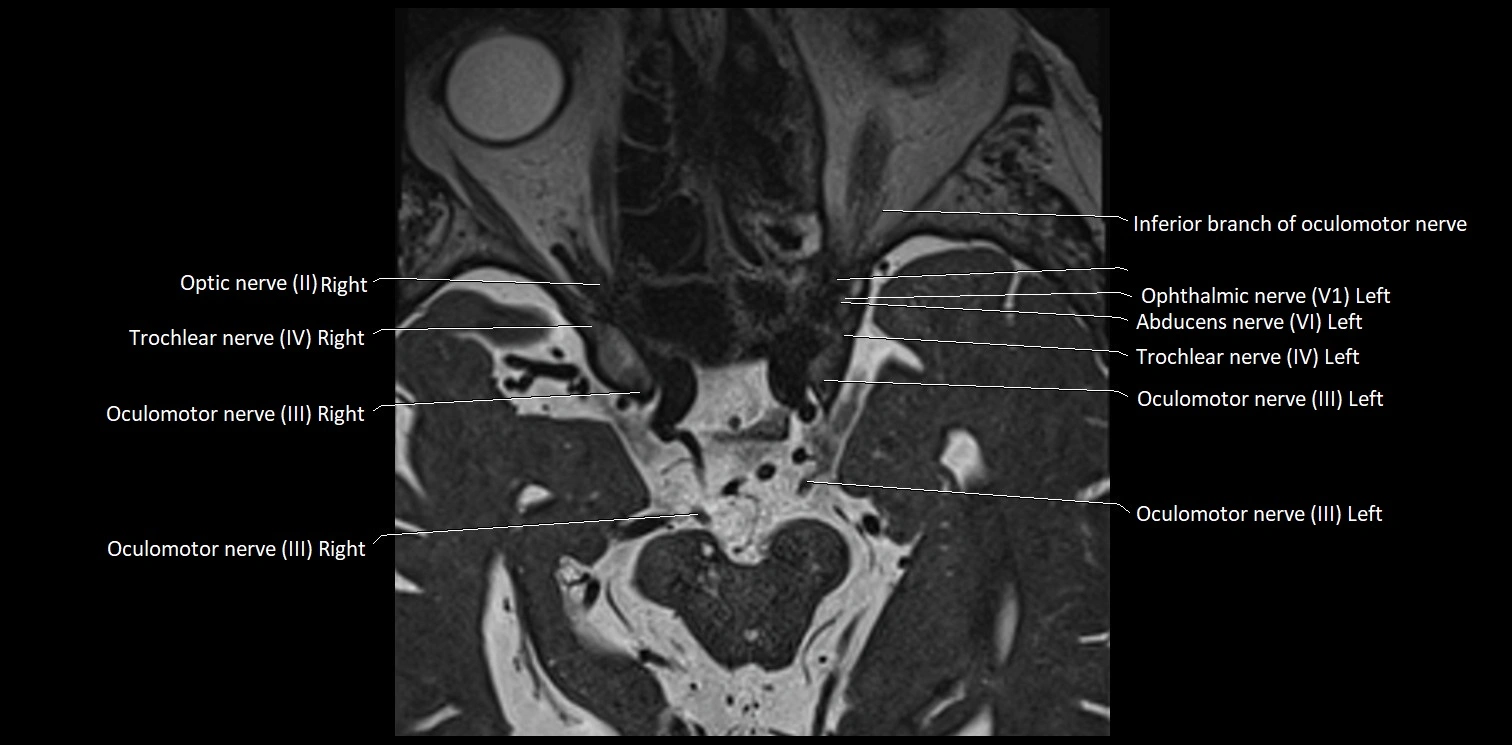 Cranial nerve anatomy axial MRI 3T image 20.webp